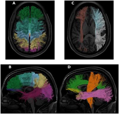 Tractometry of the Human Connectome Project: resources and insights